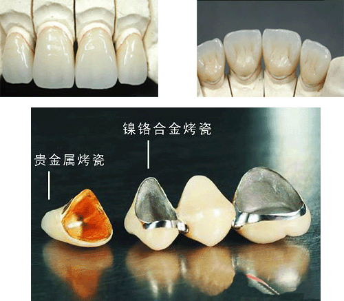 贵金属烤瓷牙的种类(贵金属烤瓷牙的种类图片)