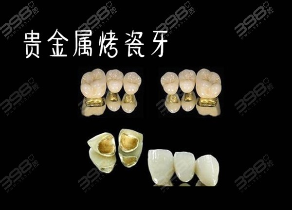贵金属烤瓷冠(贵金属烤瓷冠的特点中正确的是)