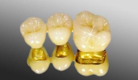 贵金属牙桩(贵金属牙桩是什么材质)