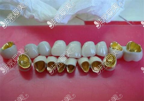 贵金属牙桩(贵金属牙桩与金属牙桩的区别)