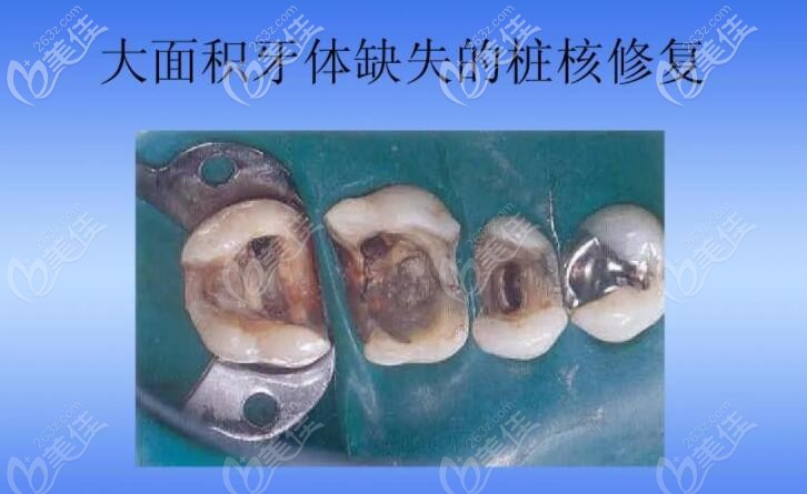 桩核贵金属(金属桩核冠修复步骤图)