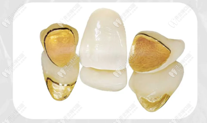 贵金属烤瓷冠(贵金属烤瓷冠的特点)
