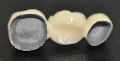 贵金属烤瓷冠(贵金属烤瓷冠多少钱一颗)