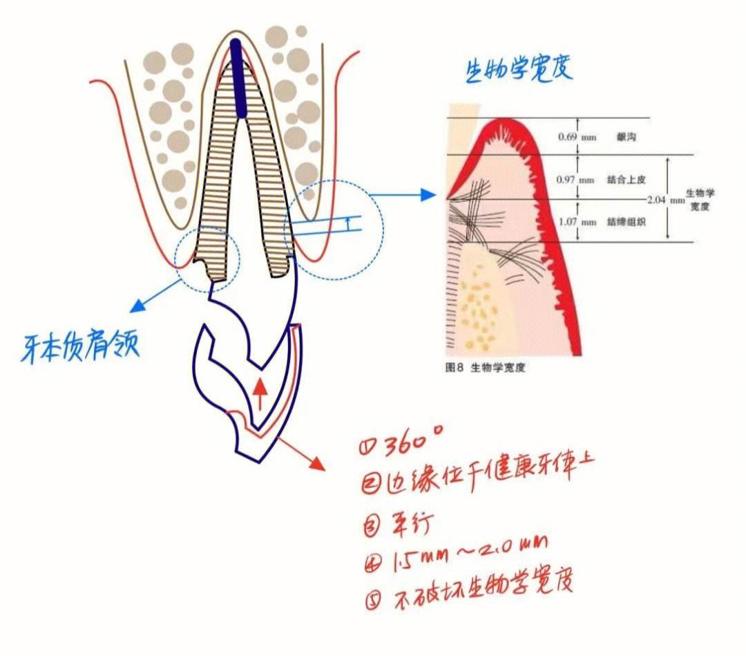 桩核贵金属(金属桩核的缺点)